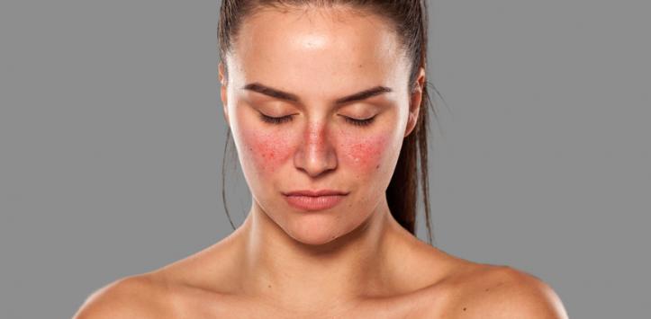 12 Subtle Lupus Symptoms That Are Easy To Miss Geelong Medical