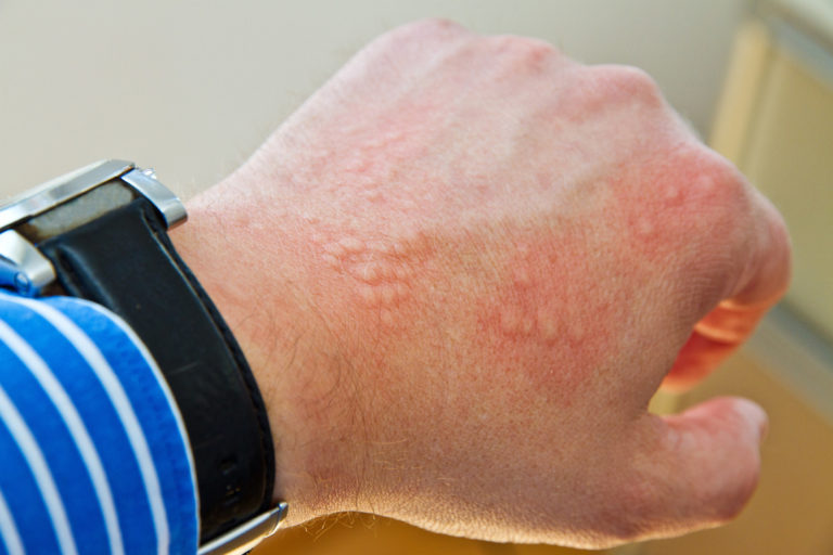 5 Causes of Hives You Wouldn't Expect Geelong Medical & Health Group